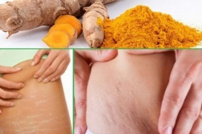 Mách mẹ bỉm sữa 3 cách chữa rạn da sau sinh bằng nghệ cực hiệu quả