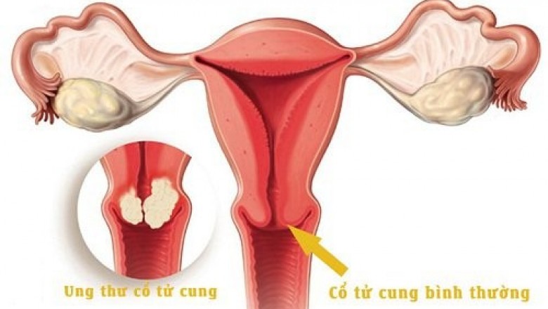 Những dấu hiệu cảnh báo ung thư cổ tử cung