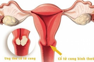 Những dấu hiệu cảnh báo ung thư cổ tử cung