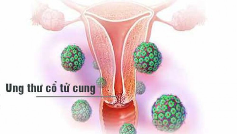 Những điều cần biết về Bệnh ung thư cổ tử cung