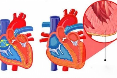 Bệnh Viêm cơ tim các dấu hiệu, triệu chứng, nguyên nhân, điều trị, cách phòng tránh