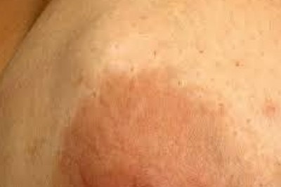 Nhận biết và phân biệt u vú lành tính và bệnh ung thư vú