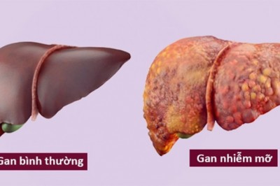 Gan nhiễm mỡ có nguy hiểm?