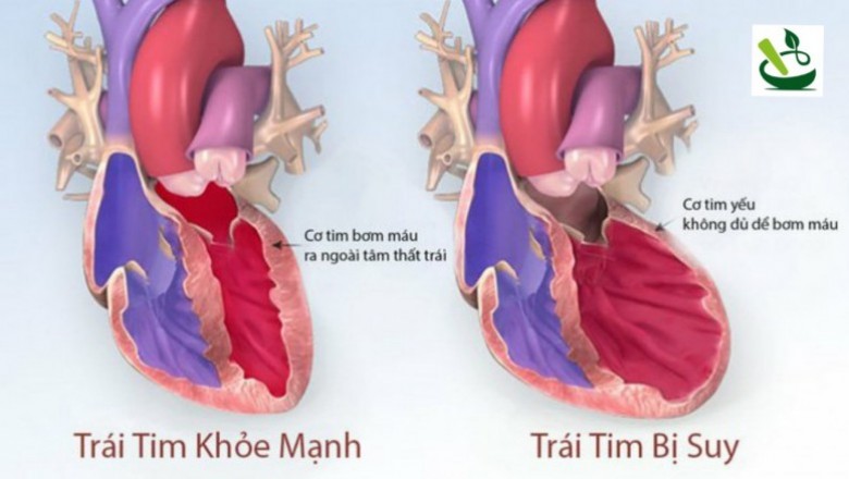 Ðông y hỗ trợ trị suy tim