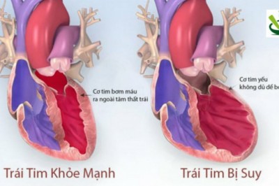 Ðông y hỗ trợ trị suy tim