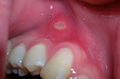 Ung thư miệng là gì? Các dấu hiệu của ung thư miệng