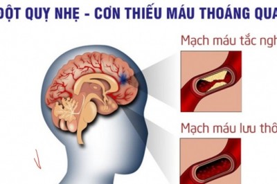 Ở Việt Nam chết do đột quỵ nhiều hơn ung thư: BS khuyến cáo những người sau có nguy cơ cao đột quỵ
