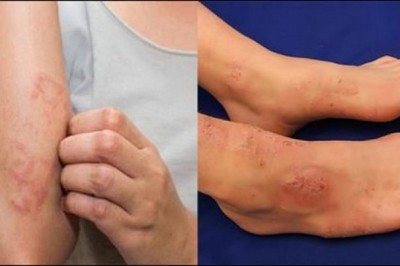 Nguyên nhân gây viêm da cơ địa và cách điều trị