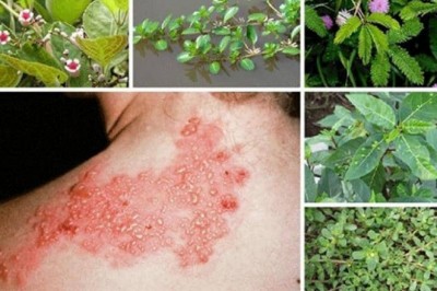 Các bài thuốc Đông y chữa zona thần kinh an toàn hiệu quả ngay tại nhà