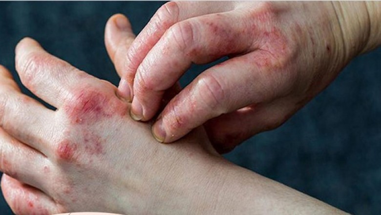 Dấu hiệu ở da cảnh báo bệnh tiểu đường