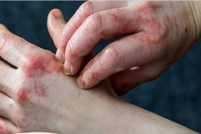 Dấu hiệu ở da cảnh báo bệnh tiểu đường