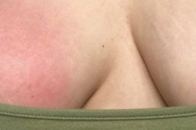 Hỏi đáp: Sau cai sữa bị viêm tuyến vú có bị làm sao không?