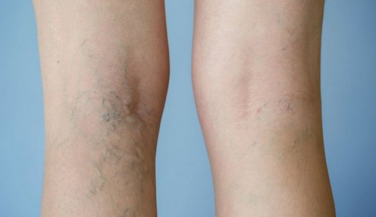 Bài thuốc trị suy giãn tĩnh mạch chân