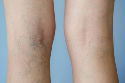 Bài thuốc trị suy giãn tĩnh mạch chân