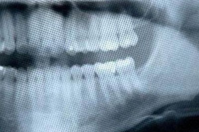 Chụp X-quang nha khoa gây ung thư não?