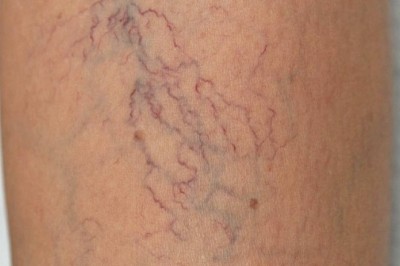 Giãn tĩnh mạch mạng nhện là bệnh gì?