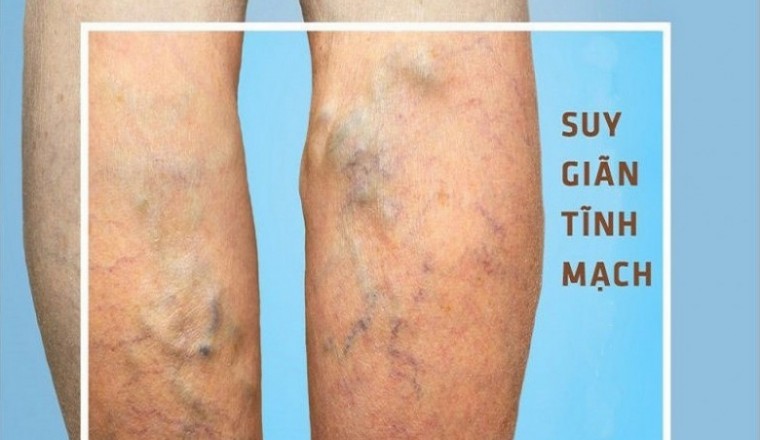 Phương pháp điều trị giãn tĩnh mạch chân
