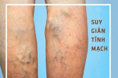 Phương pháp điều trị giãn tĩnh mạch chân