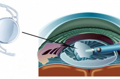 Hệ thống cấy mắt giúp tạo ra thị lực nhân tạo