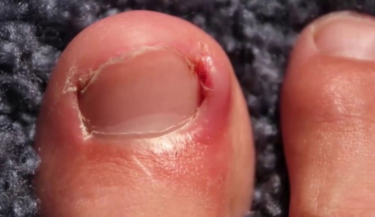 Bệnh chín mé gây biến chứng gì?