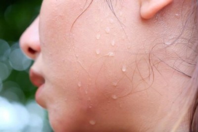 Vã nhiều mồ hôi sử dụng những bài thuốc đông y này rất hiệu quả