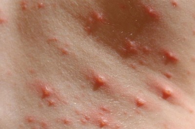 Chỉ cần thứ cỏ dại này cũng đánh bay bệnh thủy đậu ở trẻ em