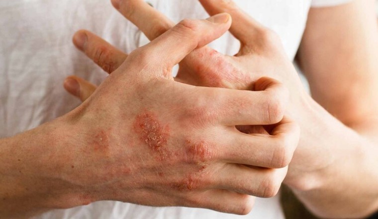 Bài thuốc nam chữa bệnh viêm da cơ địa, ngứa ngáy ngoài da