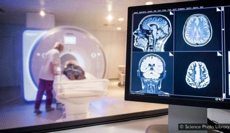 Thêm phát hiện cho thấy COVID-19 gây tổn thương não bộ