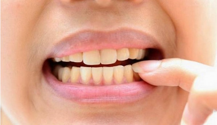 Những điều cần biết về kháng sinh và nhiễm trùng do răng