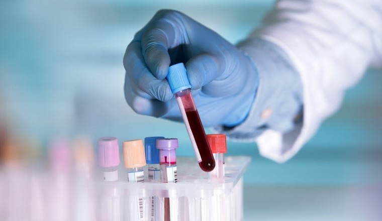 Xét nghiệm máu phát hiện sớm 50 bệnh ung thư