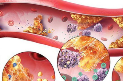 Rối loạn mỡ máu và cách phòng ngừa