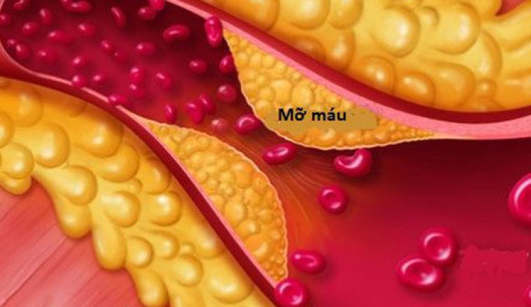 Bệnh mỡ máu cao và mười bài thuốc đông y hỗ trợ điều trị dứt điểm