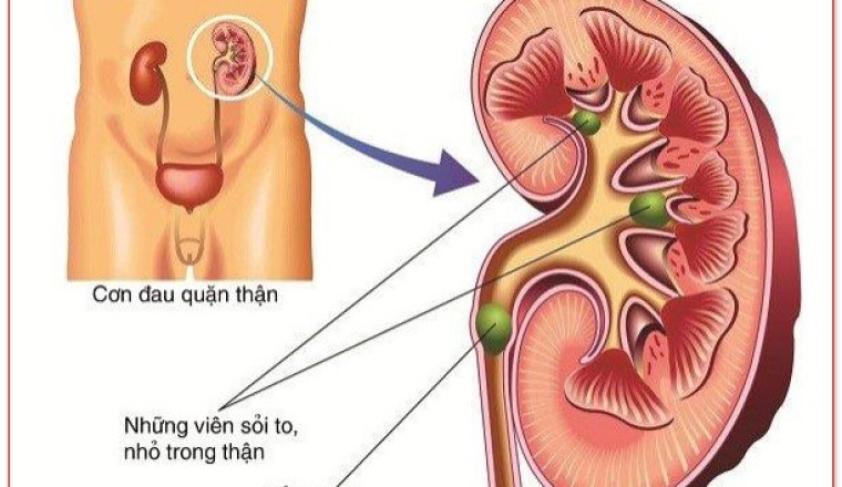 Đông y trị bệnh sỏi tiết niệu