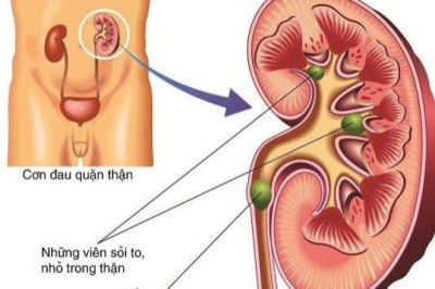 Đông y trị bệnh sỏi tiết niệu
