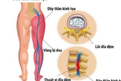 Trị đau thần kinh tọa hiệu quả bằng bài thuốc đông y