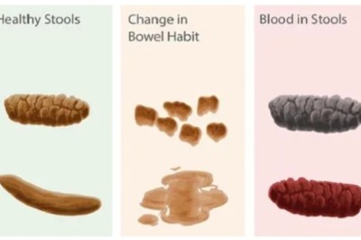 Nhận biết những dấu hiệu qua phân của bệnh ung thư đại tràng cần đi khám ngay