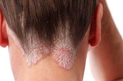 Tìm hiểu chi tiết về Bệnh Vảy Nến