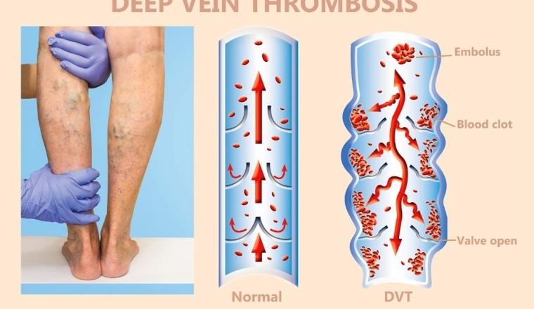 Bài thuốc đông y điều trị huyết khối tĩnh mạch sâu