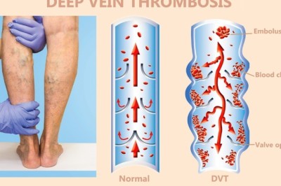 Bài thuốc đông y điều trị huyết khối tĩnh mạch sâu