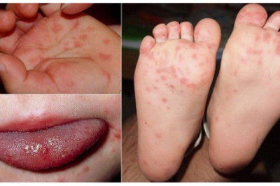 Đông y chữa bệnh chân tay miệng