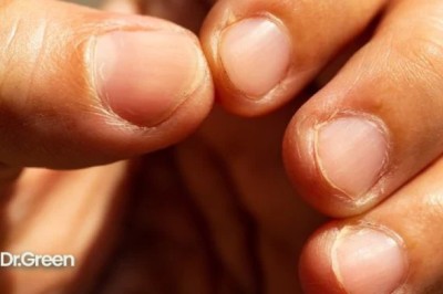 Nhận biết nhiều bệnh nguy hiểm về tim, gan, thận và kể cả ung thư đều có các dấu hiệu ở móng tay.