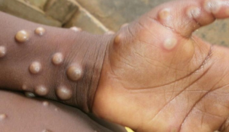 Đại dịch virus Corona kết thúc, tiếp nối là đại dịch virus đậu mùa khỉ?
