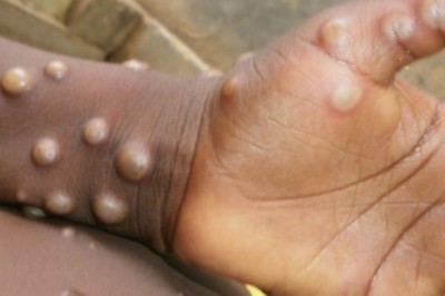 Đại dịch virus Corona kết thúc, tiếp nối là đại dịch virus đậu mùa khỉ?