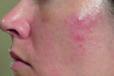 Bài thuốc nam hay điều trị viêm da tiết bã nhờn