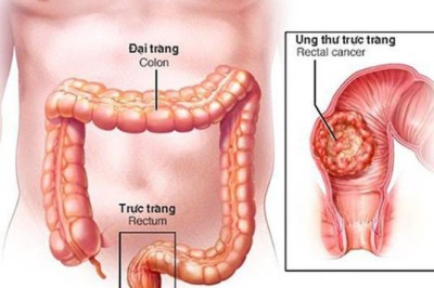 Những người đầu tiên trên thế giới được chữa khỏi hoàn toàn bệnh Ung thư trực tràng