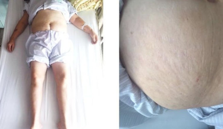 Bé 5 tuổi bị viêm gan cấp, đau khớp vì uống thực phẩm chức năng tăng chiều cao