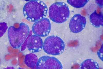 Phát hiện thuốc mới chữa khỏi ung thư