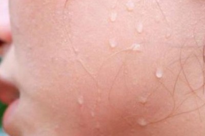 Bệnh Ung thư tuyến mồ hôi