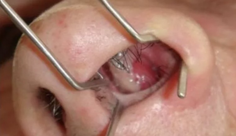 Polyp ở mũi là gi tìm hiểu chi tiết về căn bệnh Polyp ở mũi