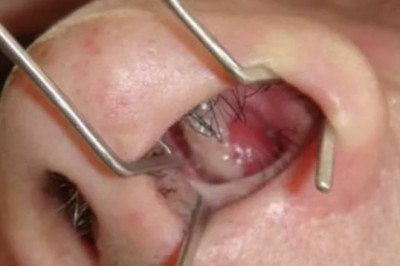 Polyp ở mũi là gi tìm hiểu chi tiết về căn bệnh Polyp ở mũi